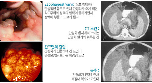 알코올성 간질환의 증상